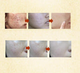 Mascarilla facial,elimina puntos negros